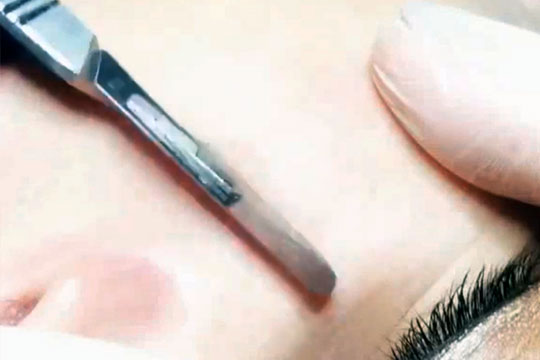 Dermal Planning - Skin Levelling - Skin Blading by Beautyologist
