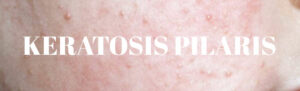 Keratosis Pilaris