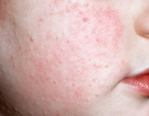 Keratosis Pilaris Skin Treatments in Melbourne by Beautyologist 2