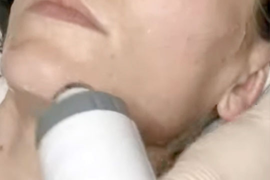Lifting & Firming RF Skin Treatment by Beautyologist