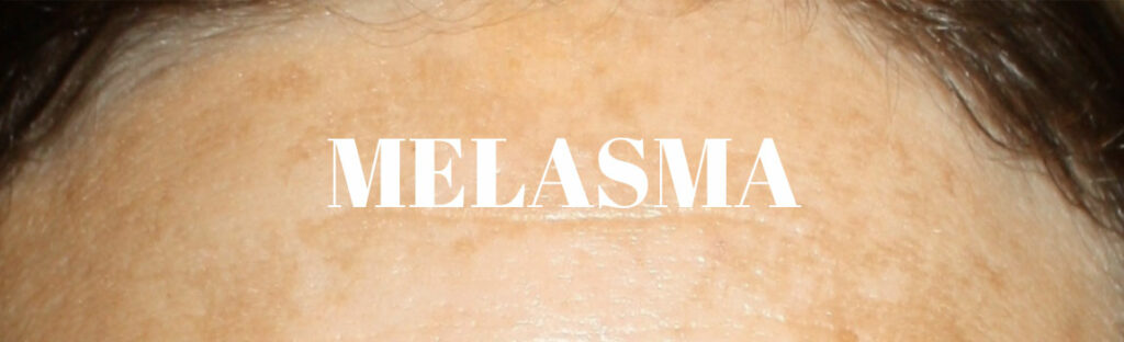 Melasma