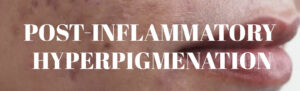 Post-inflammatory Hyperpigmenation