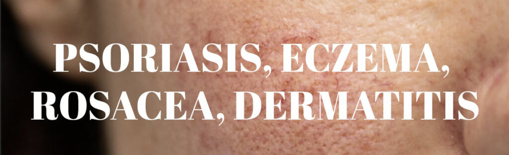 Psoriasis, Eczema, Rosacea, Dermatitis