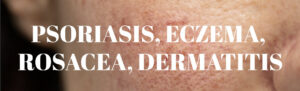 Psoriasis, Eczema, Rosacea, Dermatitis