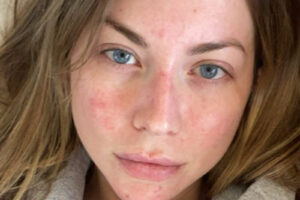 ROSACEA