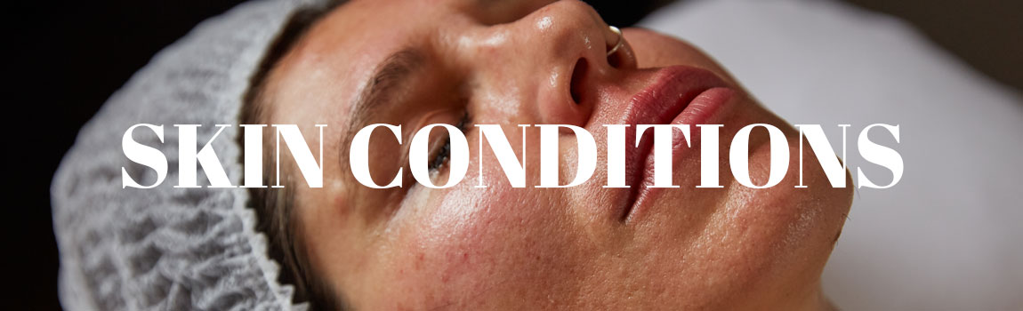 SKIN CONDITIONS