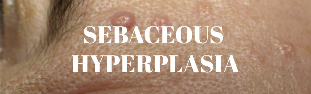 Sebaceous Hyperplasia