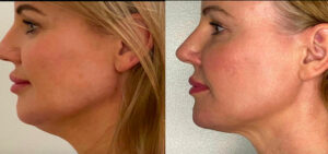 Matrix PDO Threads by Beautyologist St Kilda, VIC