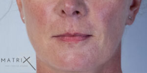 Matrix PDO Thread Lift After