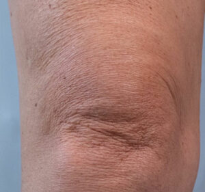 Matrix PDO Thread Lift After