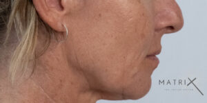 Matrix PDO Thread Lift After