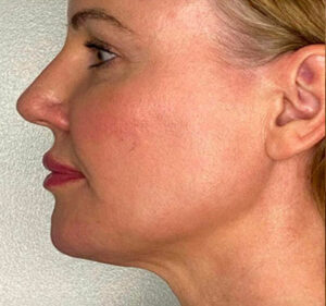 Matrix PDO Thread Lift After