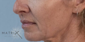 Matrix PDO Thread Lift After