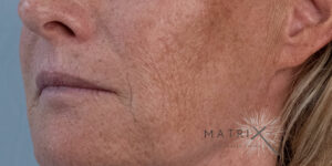 Matrix PDO Thread Lift After