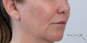 Matrix PDO Thread Lift After