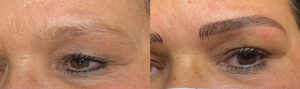 Cosmetic Tattoo Treatment in Melbourne by Beautyologist