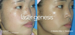 Laser Genesis Treatment in Melbourne by Beautyologist