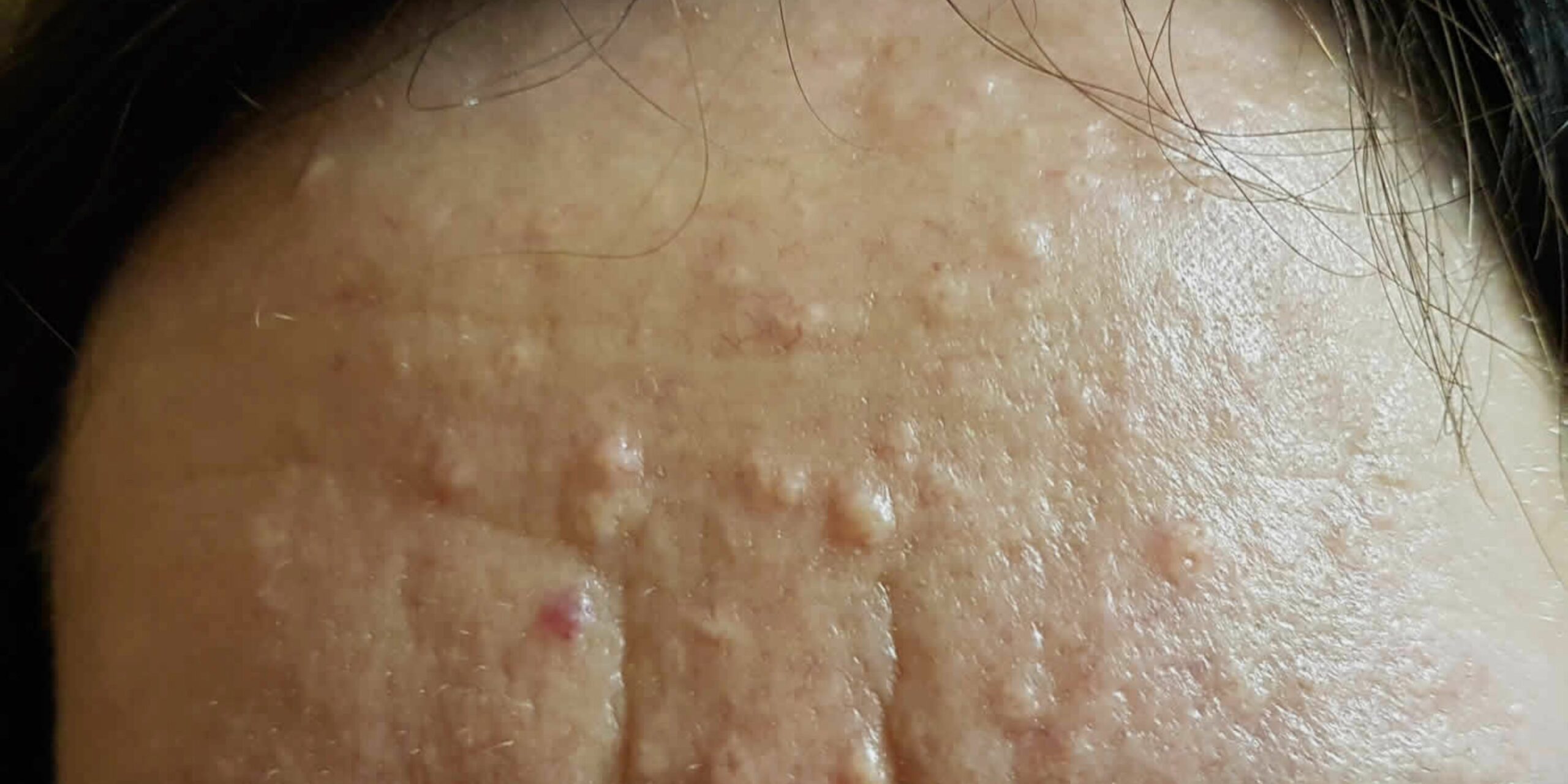 Sebaceous Hyperplasia: The Donut on Your Face You Didn’t Ask For