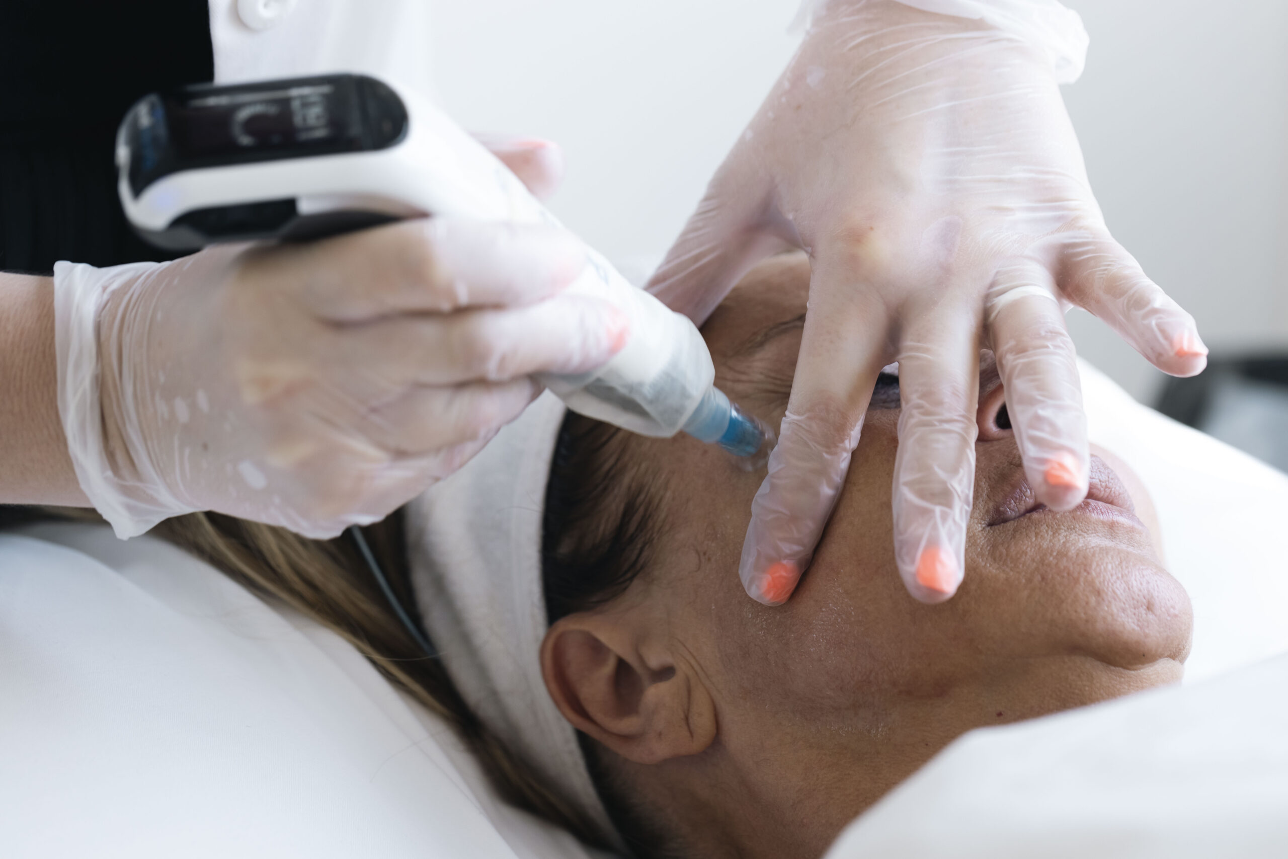 Dermapen Skin Needling Melbourne