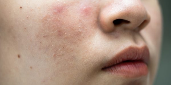 Asian young with pimple, acne, scar on skin, facial problem. Asian young with pimple, acne, scar on skin, facial problem.