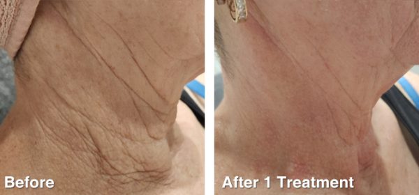RF-Skin-Tightening-13 RF-Skin-Tightening-13