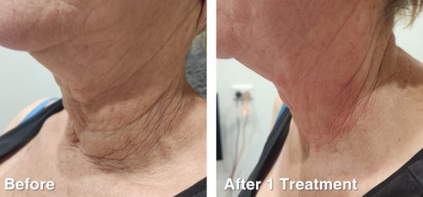 RF-Skin-Tightening-14 RF-Skin-Tightening-14