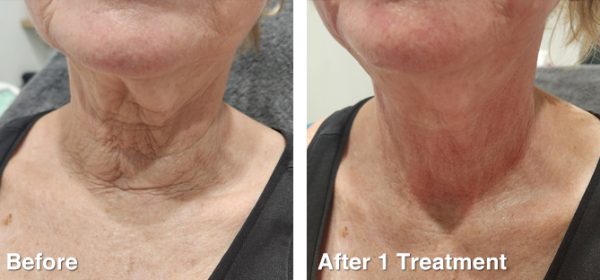 RF-Skin-Tightening-16 RF-Skin-Tightening-16